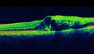黄斑部（視覚の最も鋭敏な部分）・網膜の断層画像