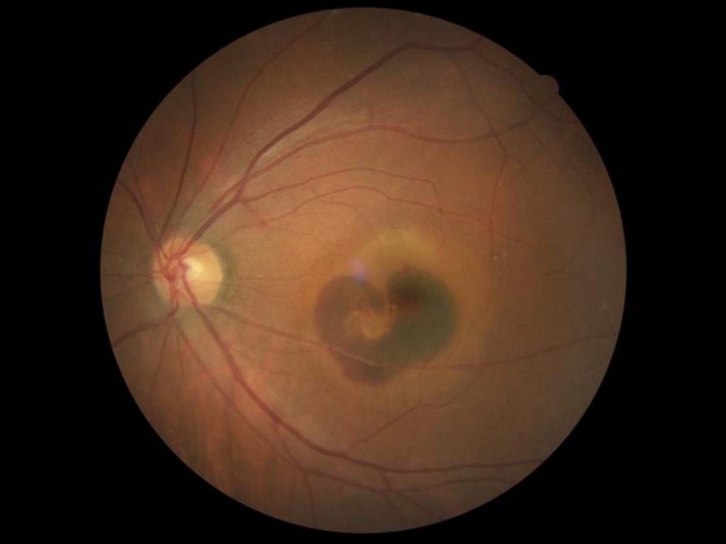 写真：左眼）ポリープ状脈絡膜血管症ポリープ状脈絡膜血管症　左眼）眼底　術前