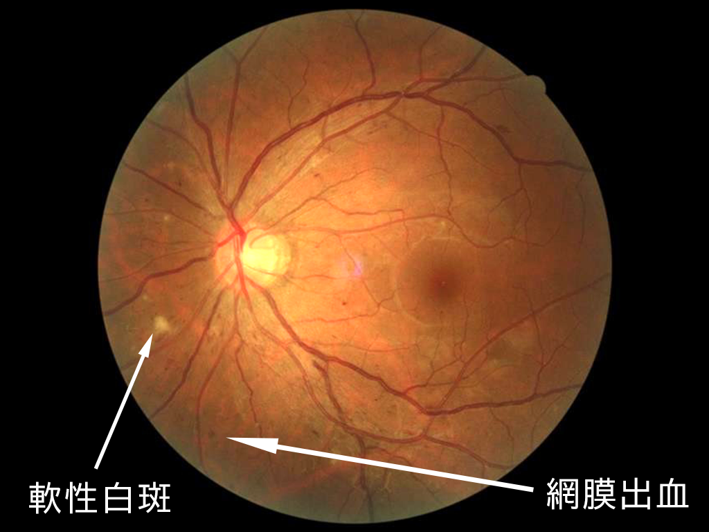 眼底検査中に何が起こるのですか?