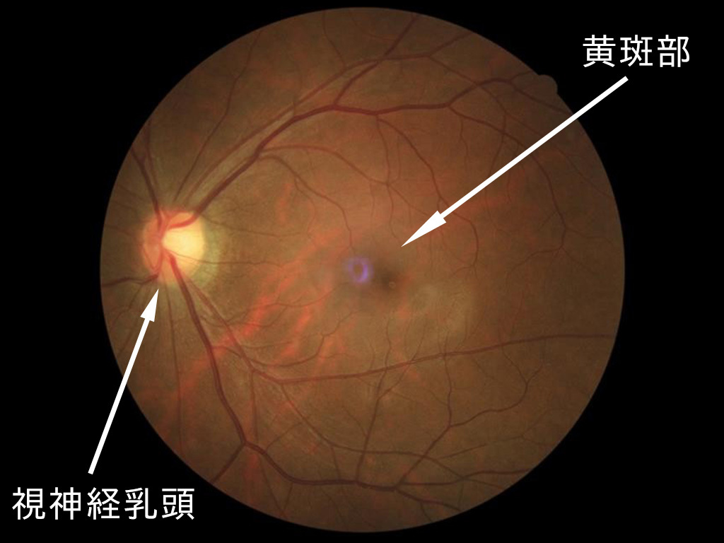 写真：左眼）正常眼底　視神経乳頭と黄斑部