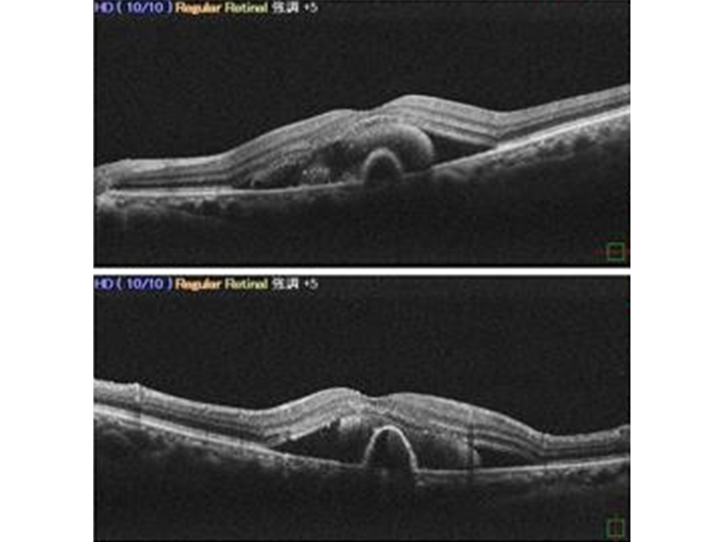 写真：左眼）加齢黄斑変性症　黄斑部断層写真